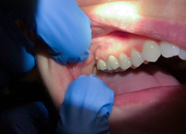 Best Emergency Dental Care for Sports Injuries in Smithville, MO