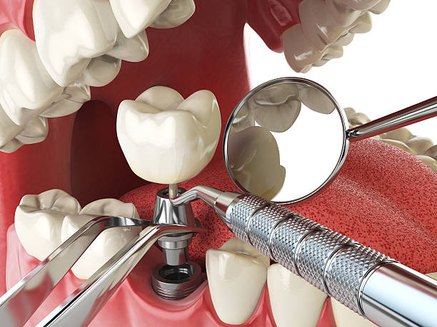 Best Lost Filling or Crown Replacement in Smithville, MO